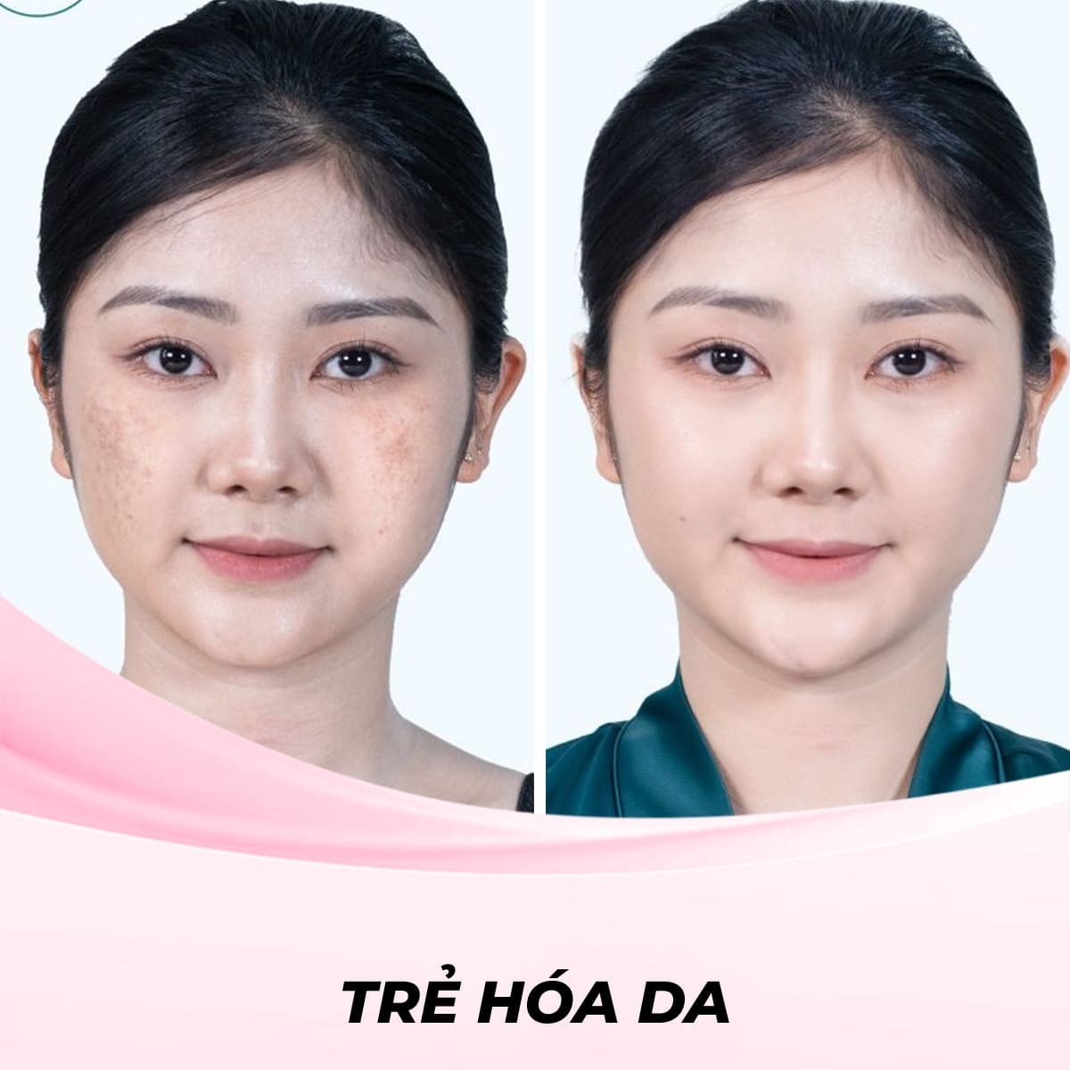 Trẻ hóa da bằng phương pháp làm đầy bằng Filler