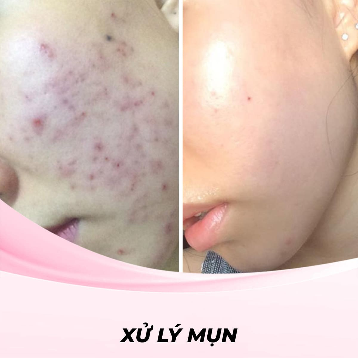 Lấy nhân mụn – Dịch vụ làm sạch da chuyên sâu