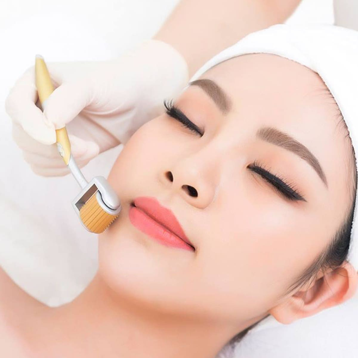 Xử lý nám bằng phương pháp lăn kim kết hợp tế bào gốc