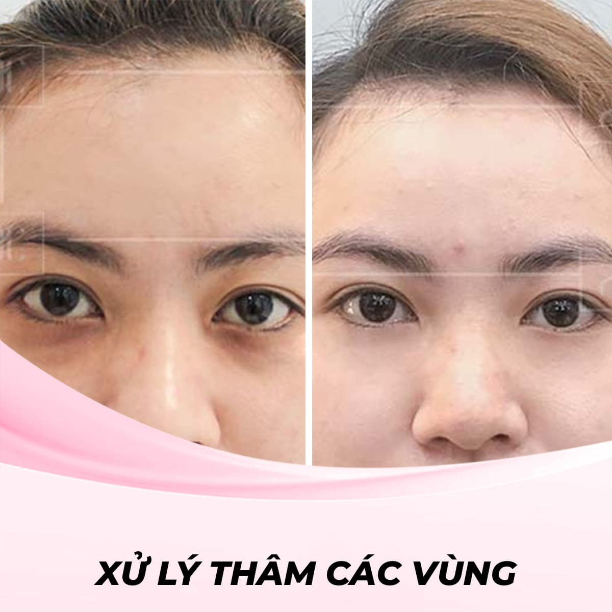 Xử lý Thâm Quầng Mắt bằng phương pháp laser