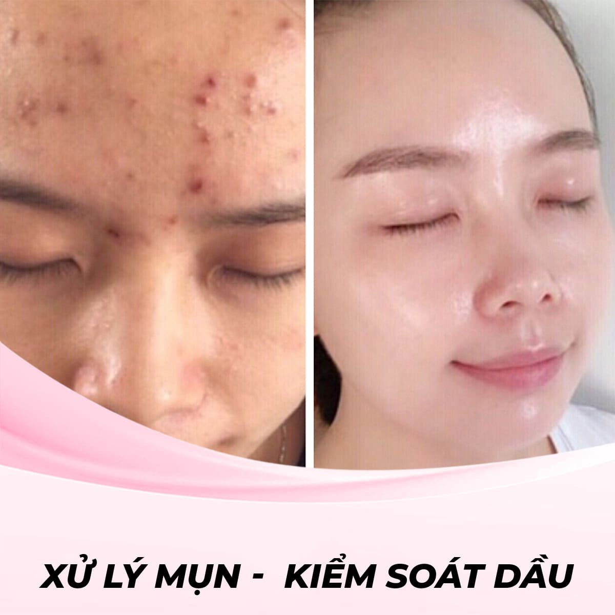 Xử lý mụn - kiểm soát dầu với công nghệ Toning Laser