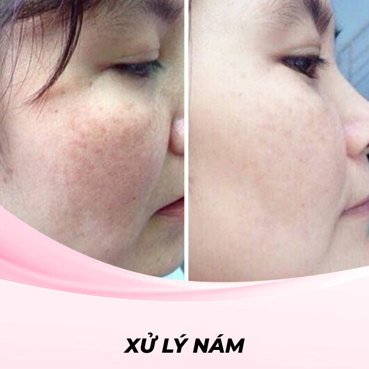 Xử lý nám bằng phương pháp lăn kim kết hợp tế bào gốc