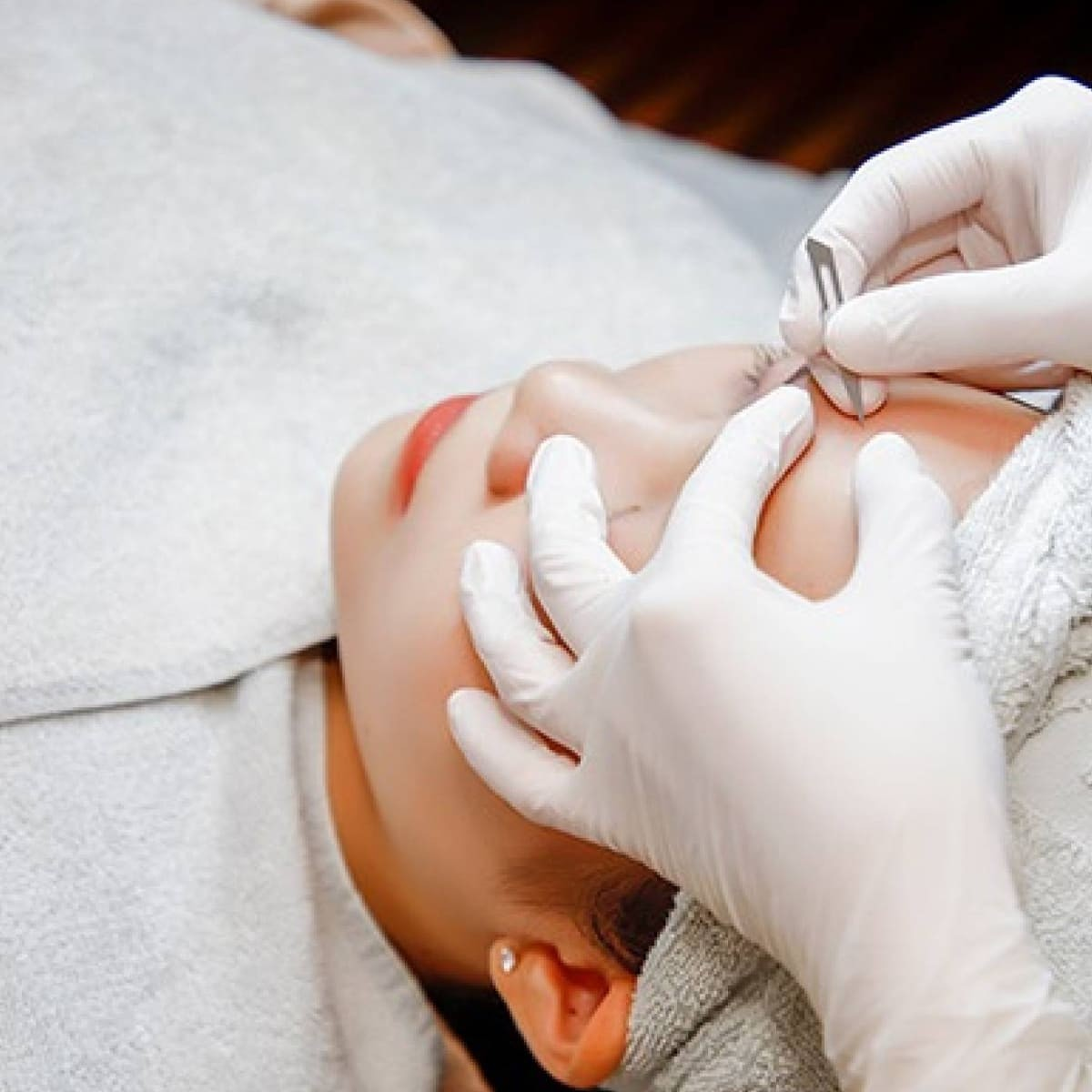 Lấy nhân mụn – Dịch vụ làm sạch da chuyên sâu