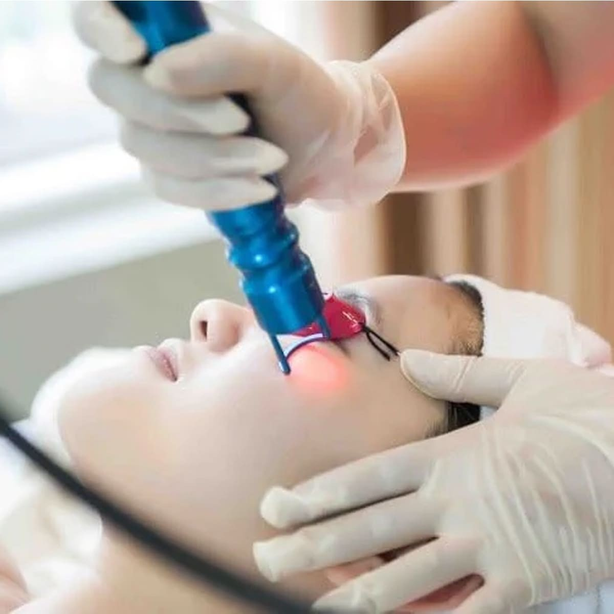 Xử lý Thâm Quầng Mắt bằng phương pháp laser