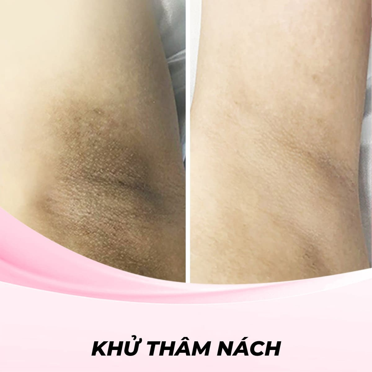 Khử thâm nách bằng Công nghệ RF (Radio Frequency)