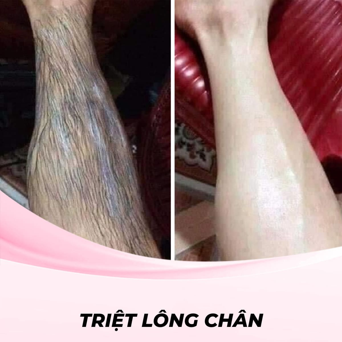 Triệt Lông Chân Bằng Sáp ( Waxing)